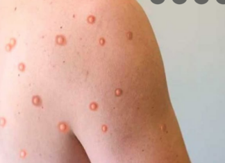 SSA: En la última semana se confirmaron 316 nuevos casos de viruela del mono