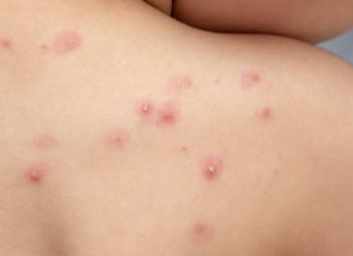 OMS cambia el nombre de la viruela del mono a mpox