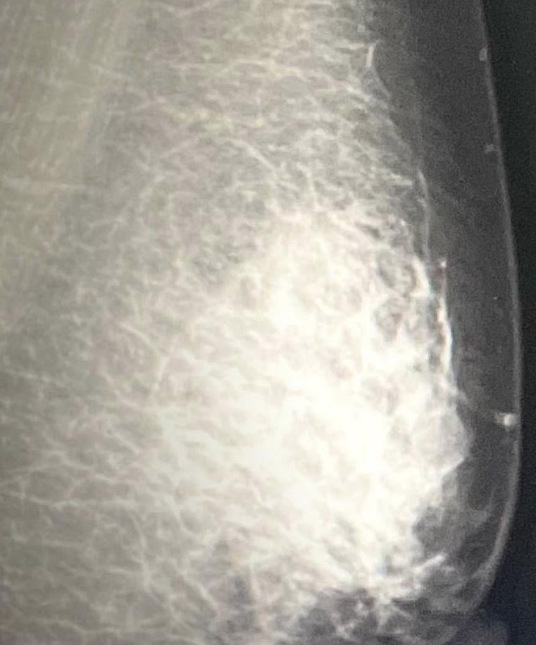 Realiza IMSS Michoacán jornadas de mastografías