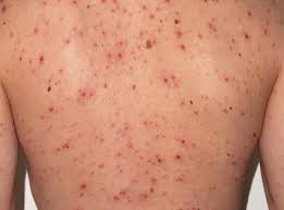 Sarampión, enfermedad reemergente | MÁSNOTICIAS